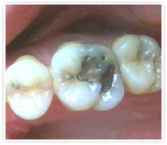 Лечение Кариеса в Орле
