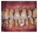 Лечение пародонтоза в Орле