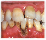 Лечение периодонтита в Орле