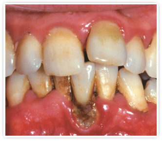 Лечение периодонтита в Орле