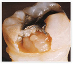 Лечение пульпита в Орле