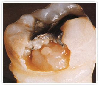 Лечение пульпита в Орле