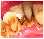 Удаление зубного камня в Орле