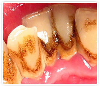 Удаление зубного камня в Орле